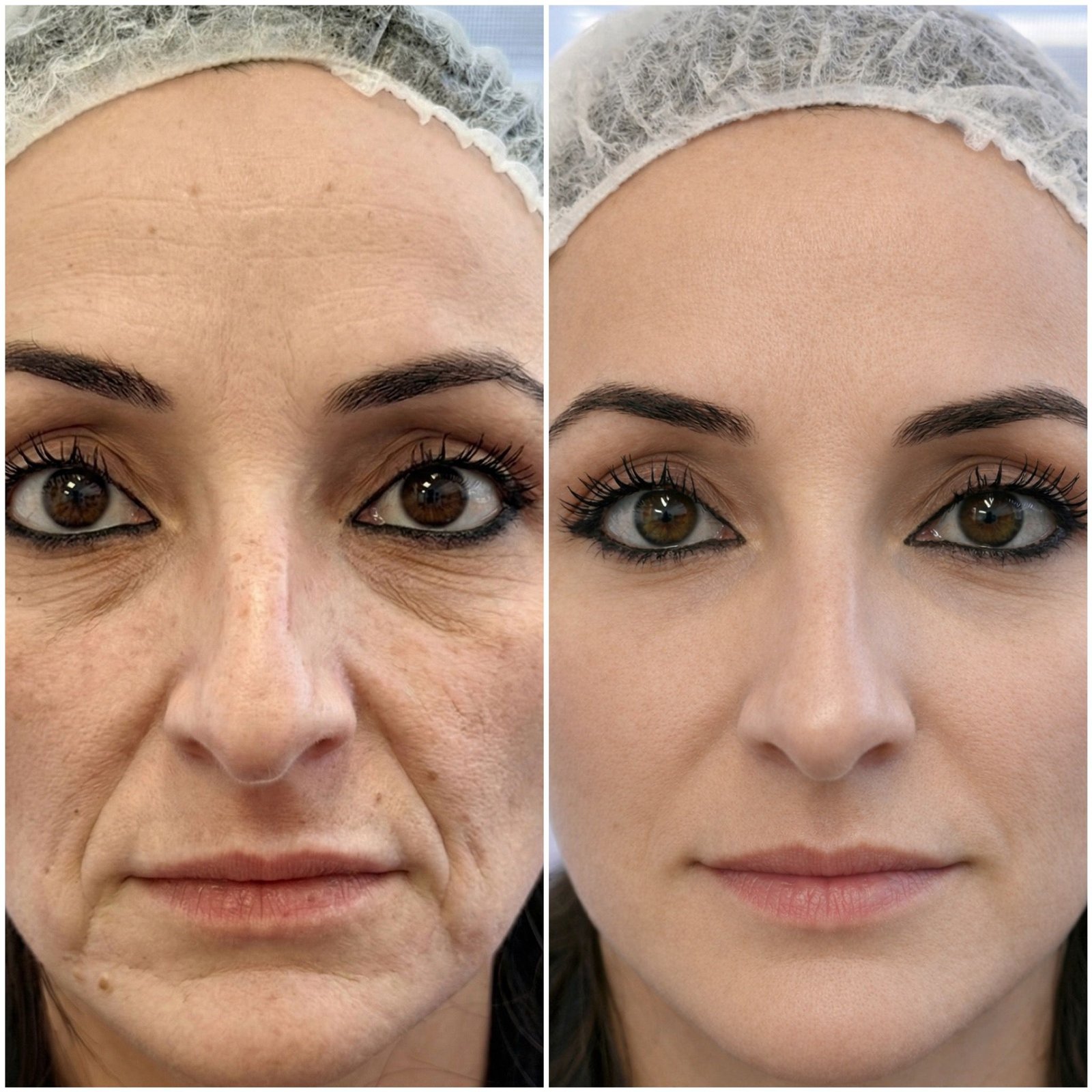 תוצאות טיפול פרימיום לפני ואחרי